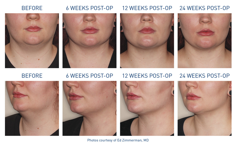 mm0194.01-renuvion-before-after-neck-3-flyer-zimmerman_72dpi