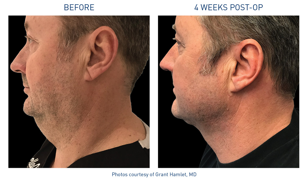 mm0200.01-renuvion-before-after-neck-4-flyer-hamlet_72dpi