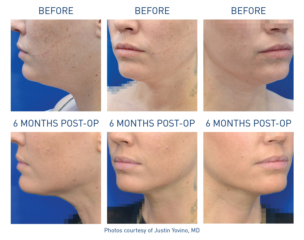 mm0201.01-renuvion-before_after_neck-5-flyer-yovino_72dpi