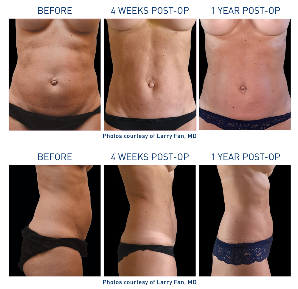 mm0216.02-renuvion-before-after-abdominal-3-flyer-fan_72dpi