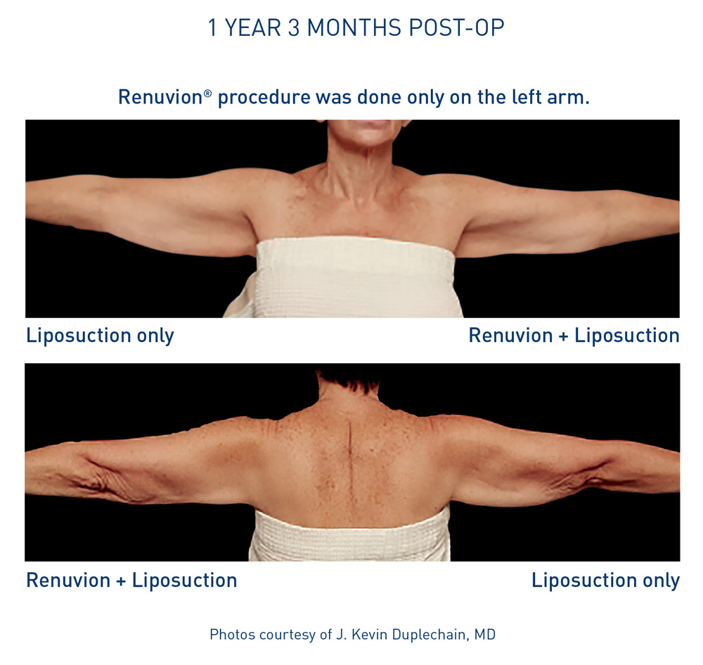 mm0220.01-renuvion-before-after-arms-3-flyer-duplechain_72dpi