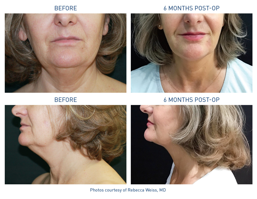 mm0287.01-neck_11_weiss_72dpi