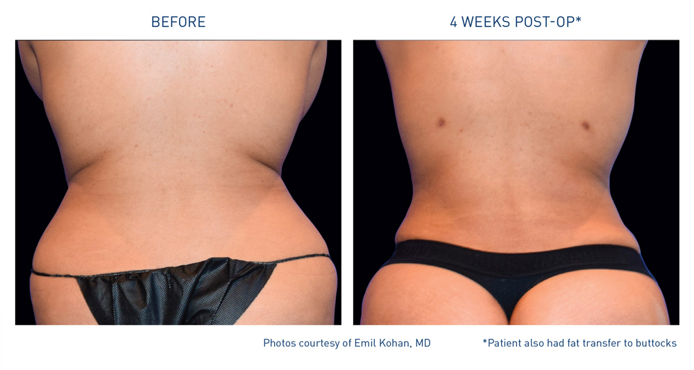 mm0290.00-back-and-flanks_1_kohan_72dpi