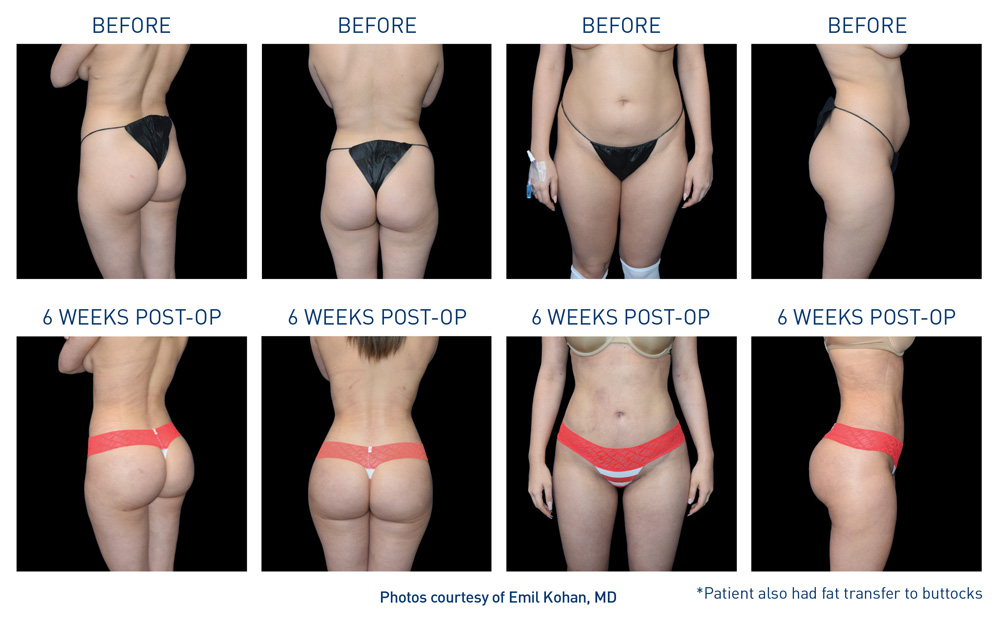 mm0295.01-renuvion-before-after-body-1-flyer-kohan_72dpi