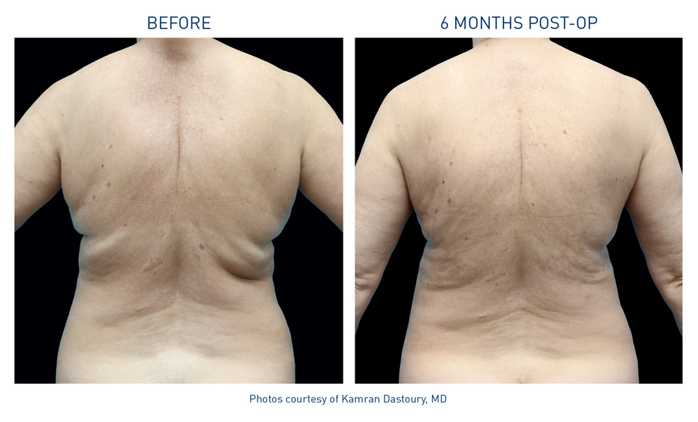 mm0344.01-renuvion-before-after-back-4-flyer-dastoury_72dpi