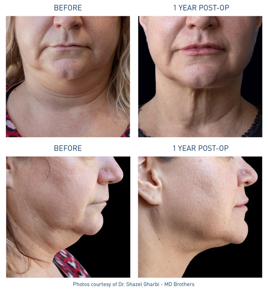 mm0366.01-renuvion-before-after-neck-13-flyer-gharbi_72dpi