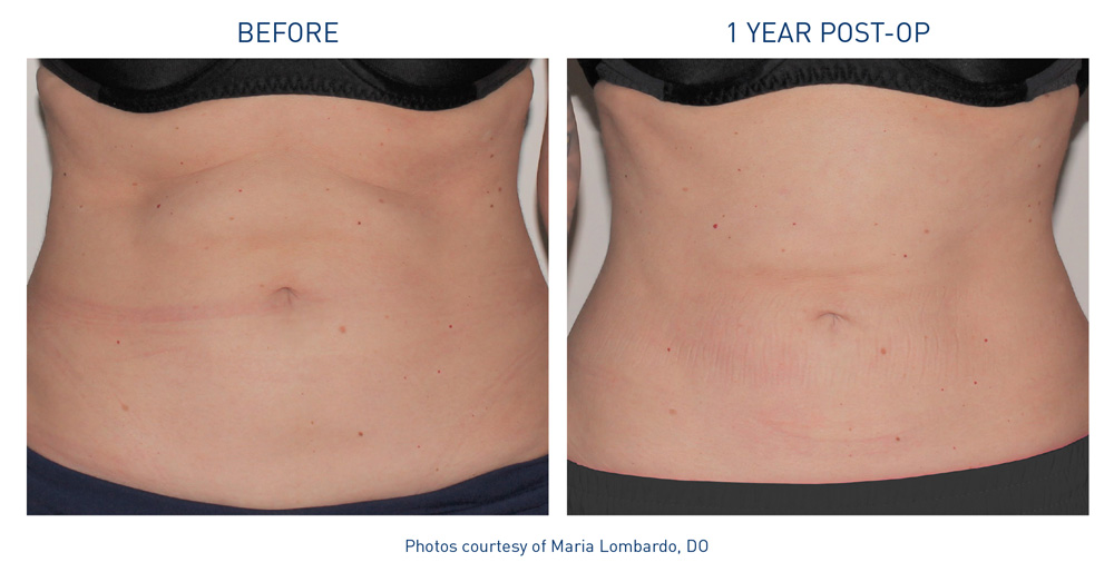 mm0367.01-before-after-abdomen-9-flyer-lombardo_72dpi