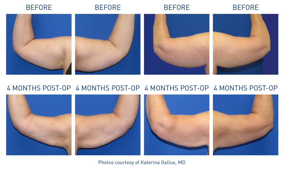 mm0393.01-renuvion-before-after-arms-7-flyer-gallus_72dpi