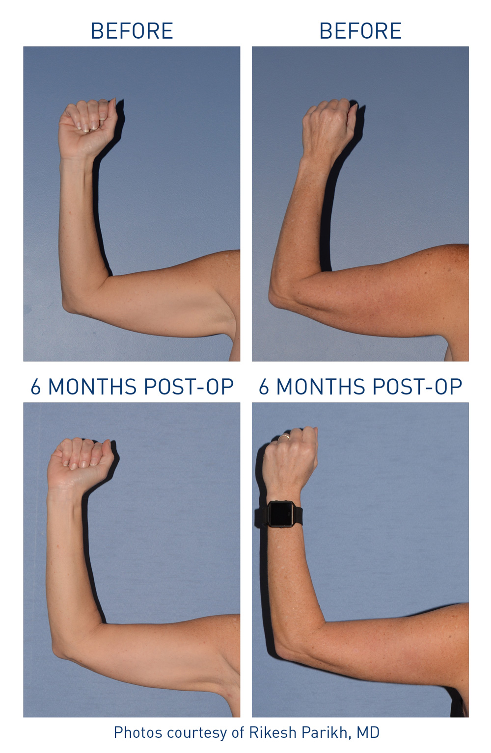 mm0422.01-renuvion-before-after-arms-8-flyer-parikh_72dpi