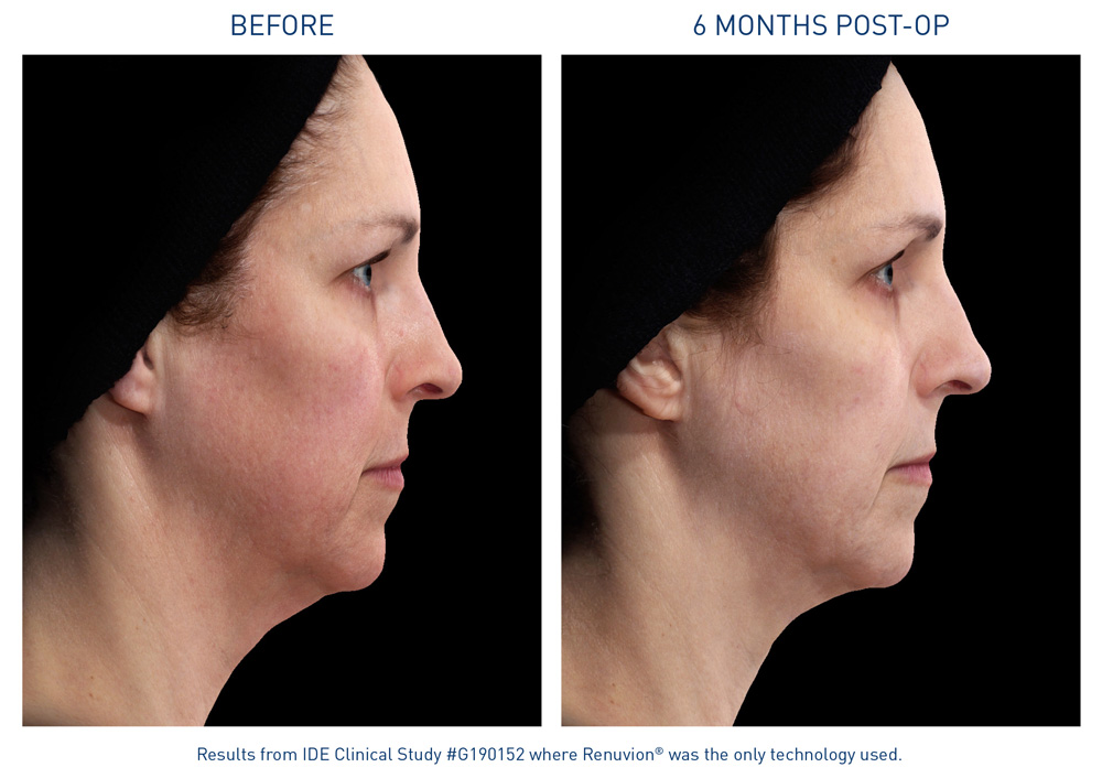 mm0465.01-renuvion-before-after-neck-laxity_72dpi
