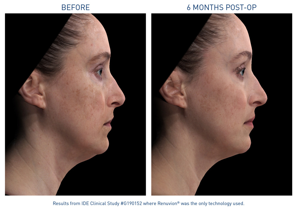 mm0468.01-renuvion-before-after-neck-laxity-flyer_72dpi