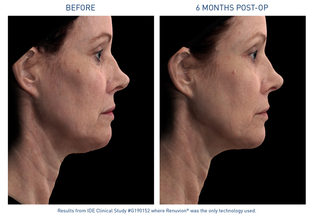mm0469.01-renuvion-before-after-neck-laxity-flyer_72dpi