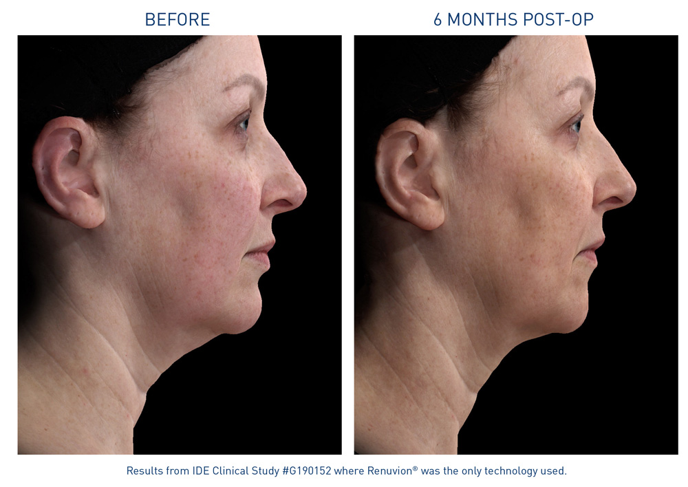 mm0471.01-renuvion-before-after-neck-laxity-flyer_72dpi