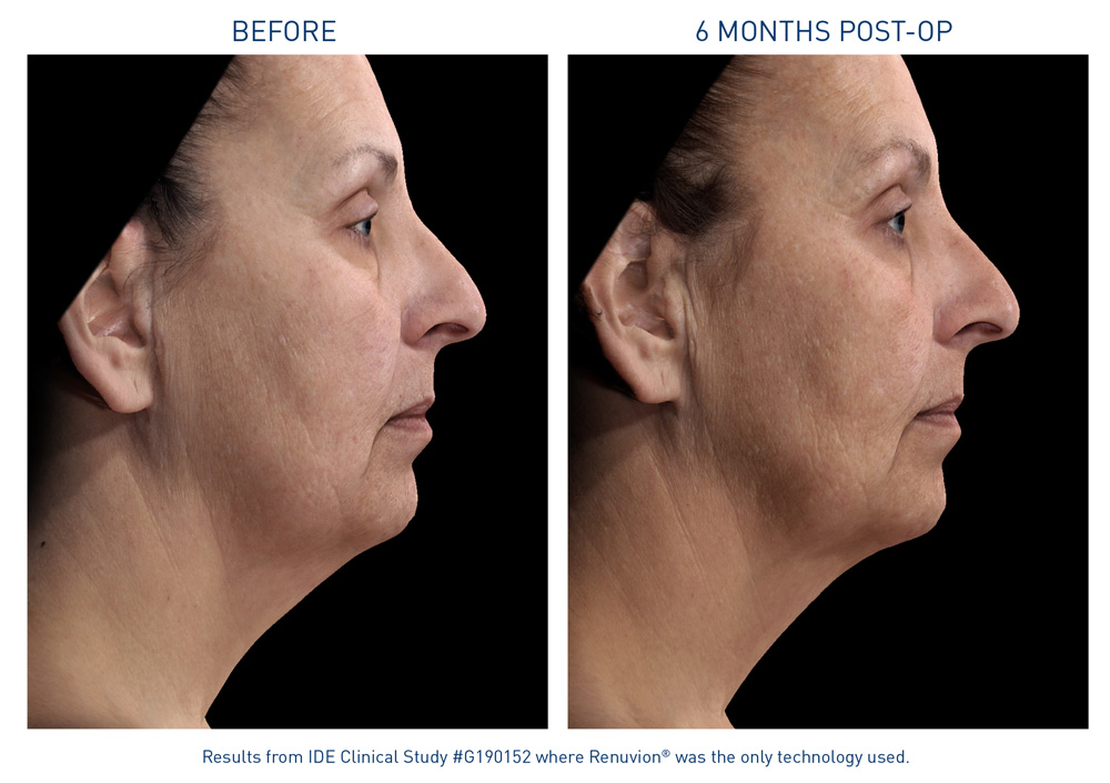 mm0472.01-renuvion-before-after-neck-laxity-flyer_72dpi