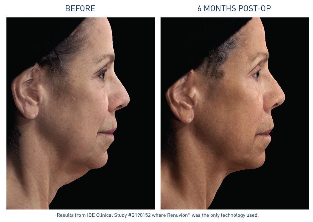 mm0473.01-renuvion-before-after-neck-laxity-flyer_72dpi