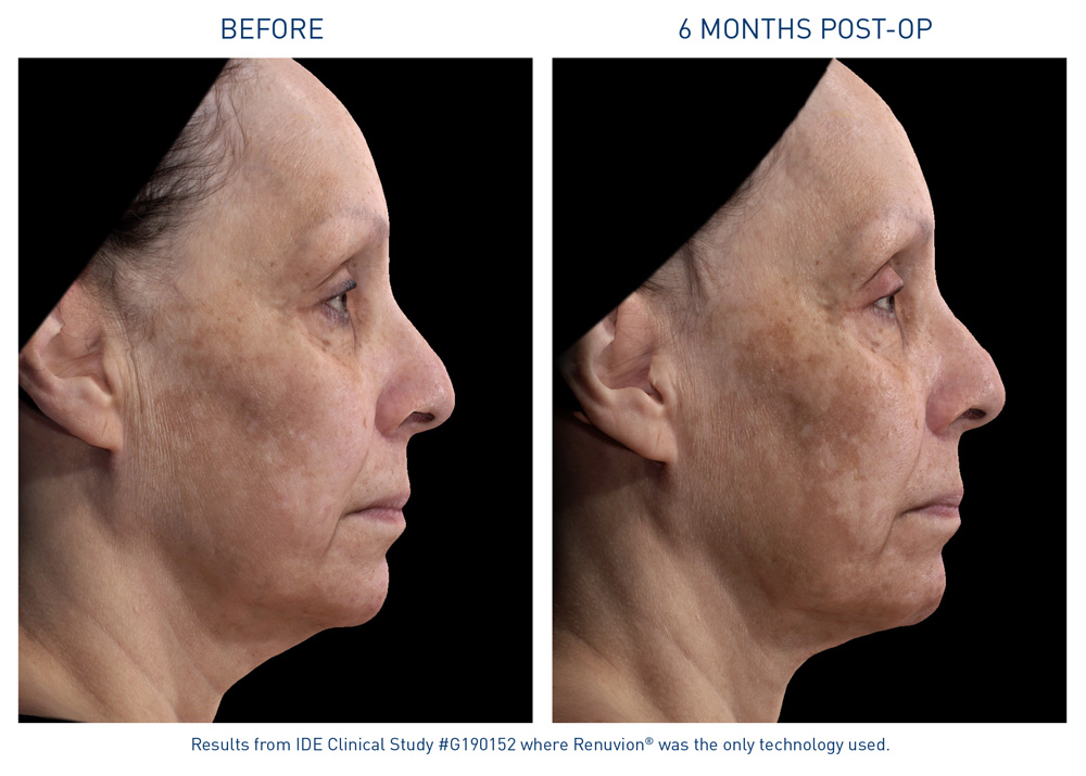 mm0474.01-renuvion-before-after-neck-laxity-flyer_72dpi