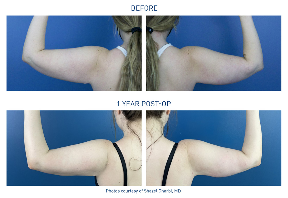 mm0514.01-renuvion-before-after-arms-10-flyer-gharbi_72dpi