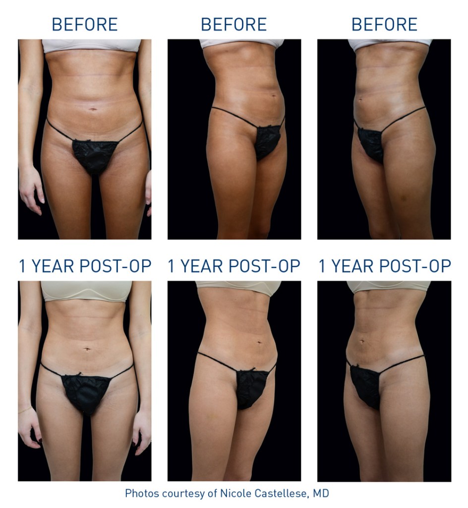mm0542.00-renuvion-before-after-body-flyer-castellese_72dpi