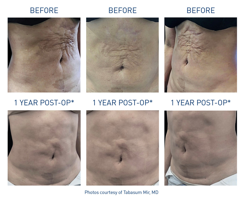 mm0573-00-renuvion-before-after-abdominal-flyer-mir-72dpi