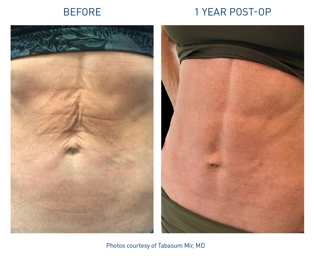 mm0574-00-renuvion-before-after-abdominal-flyer-mir_72dpi