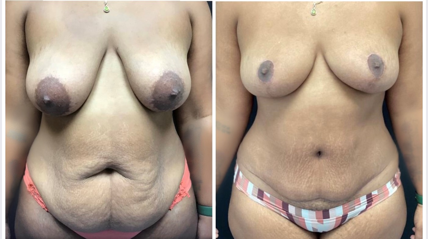 mommy-makeover-study-photos