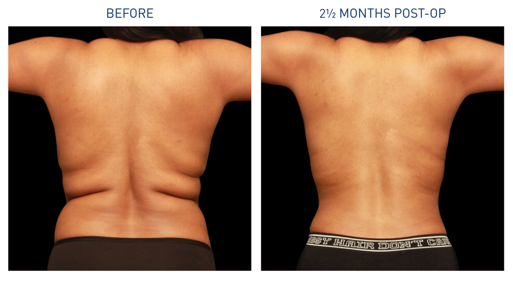 renuvion-ba-back-axilla-flanks-1-ba-photos-duplechain-mm0322-01-082923_v2-72dpi