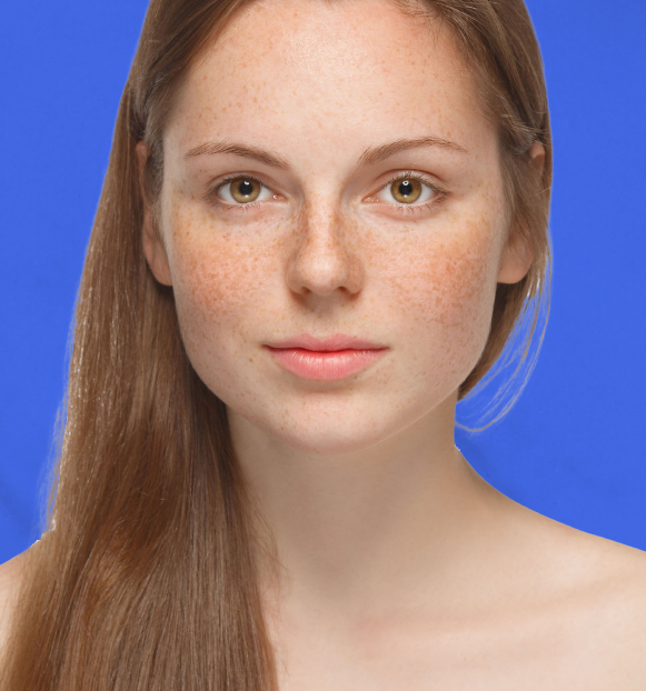 NORDLYS LASER TREATMENT